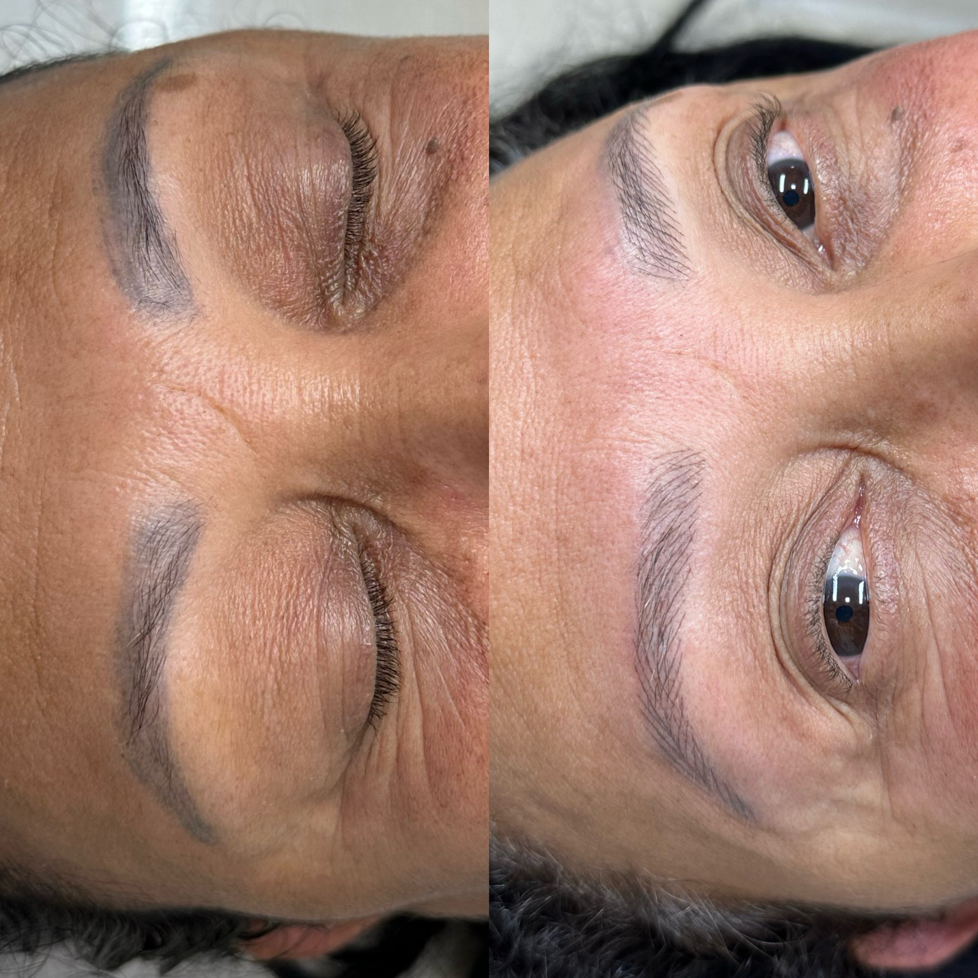 Antes e depois , Método Renova Skin 