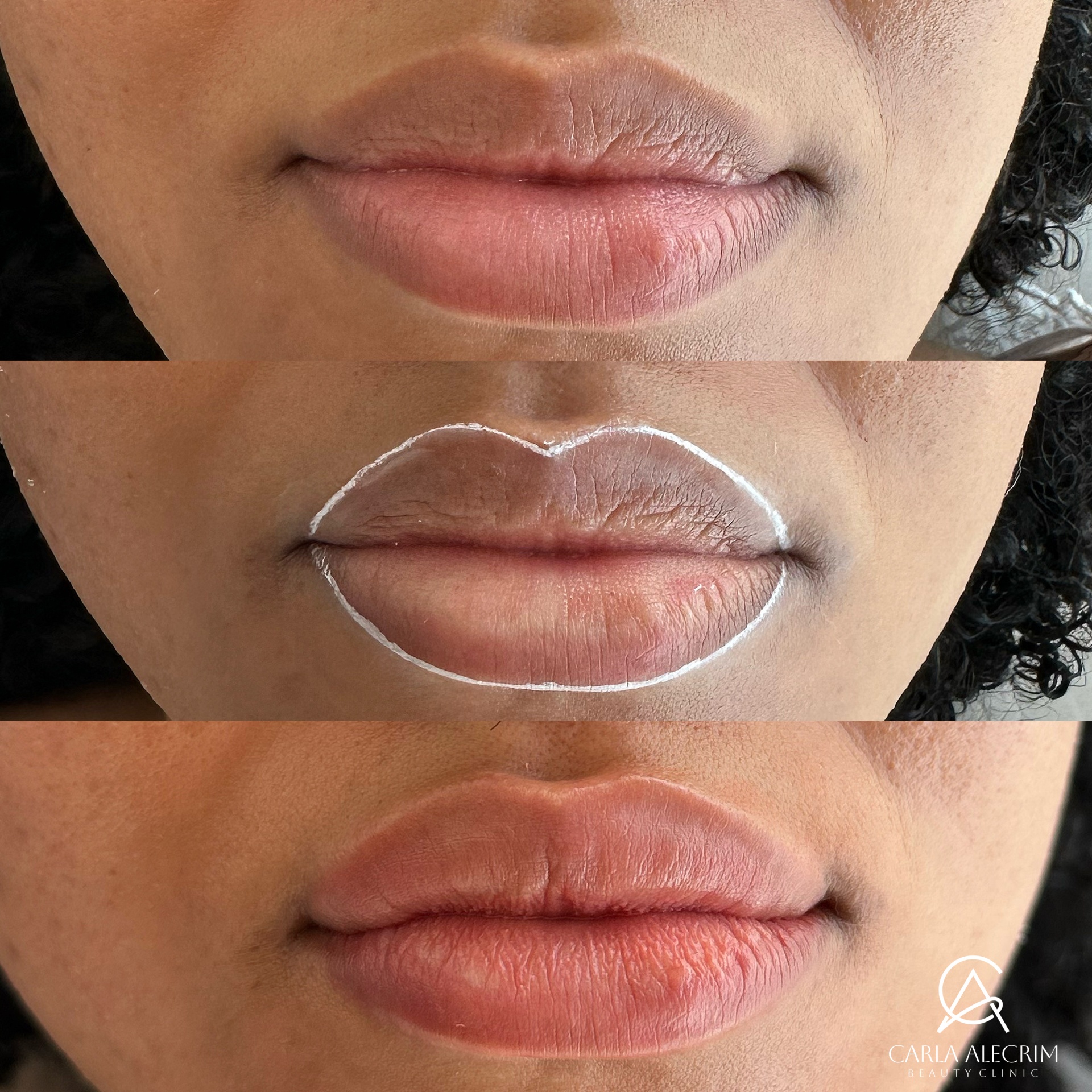 Antes e depois , Micropigmentação labial